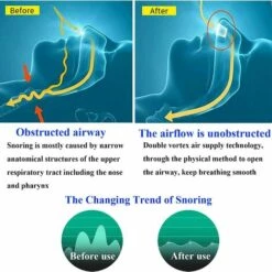 ZHUOXUAN Dispositifs Anti-Ronflement, Dilatateur Nasal, Traitement Anti Ronflements Pour Stop Ronflement, Pour Un Sommeil Confortable 9 ZHUOXUAN Dispositifs Anti-Ronflement, Dilatateur Nasal, Traitement Anti Ronflements Pour Stop Ronflement, Pour Un Sommeil Confortable -Protection des voies respiratoires Soldes 51450453 3