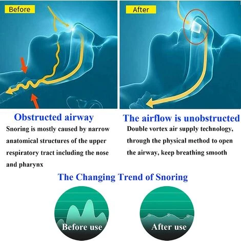 ZHUOXUAN Dispositifs Anti-Ronflement, Dilatateur Nasal, Traitement Anti Ronflements Pour Stop Ronflement, Pour Un Sommeil Confortable 5 ZHUOXUAN Dispositifs Anti-Ronflement, Dilatateur Nasal, Traitement Anti Ronflements Pour Stop Ronflement, Pour Un Sommeil Confortable – Image 3
